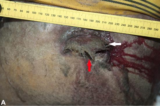 一条鳎鱼(箭头处)堵住了领航鲸的喷气孔。