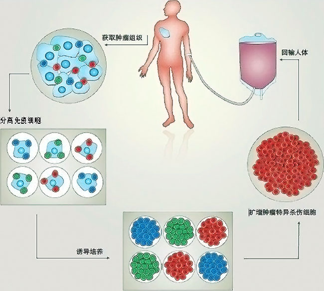 自体体细胞免疫治疗