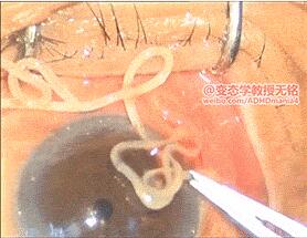 眼球上的寄生虫 非洲眼线虫图片 211228