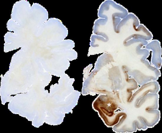 左图为正常大脑，右图深色区为Tau蛋白异常聚集