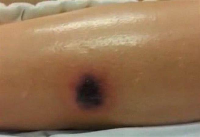 Keith Pierce腿上出现黑色印记。