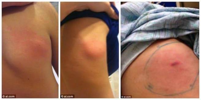 棕色遁蛛咬伤的伤口与一般蚊虫叮咬相似。