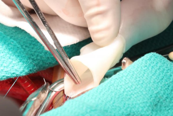 可以在人体内生长的动脉