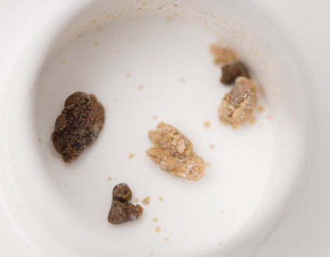 坐过山车可能有益身体健康，比如排石