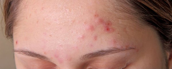 长痘的人老得慢