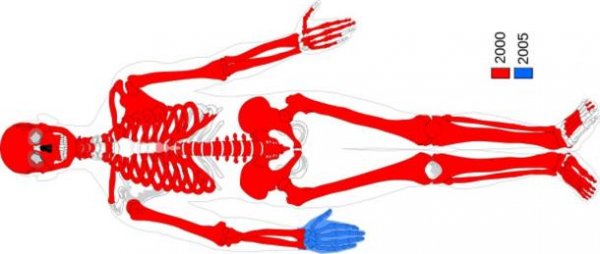 沼泽木乃伊：是失踪女孩还是古代女尸？
