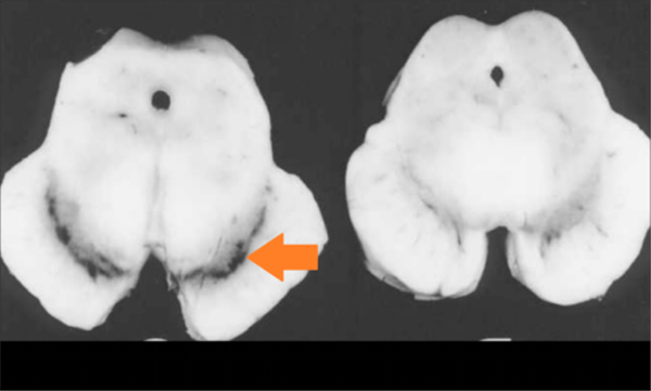 怎么区别帕金森病、老年痴呆和渐冻人症？