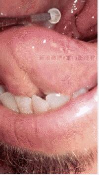 寄生在人嘴里的贝蒂寄生虫图片 212744