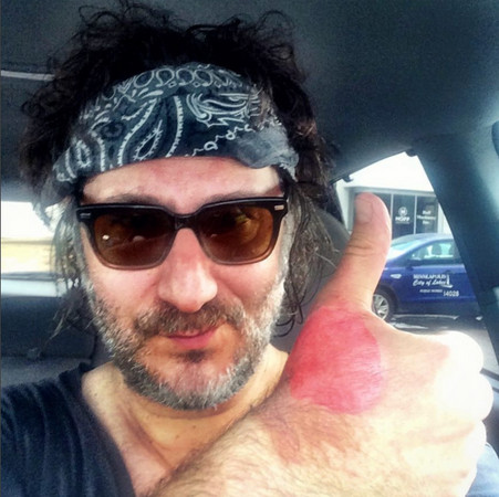 阳光下挤莱姆 竟害他手背冒出“鸡蛋大水泡”。（图／翻摄instagram／adamlevy）