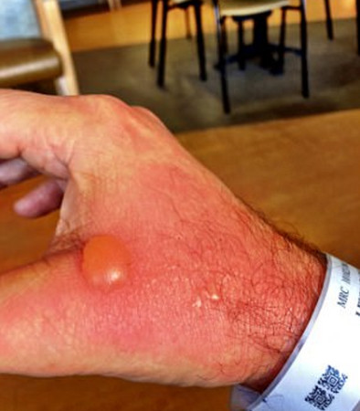 阳光下挤莱姆 竟害他手背冒出“鸡蛋大水泡”。（图／翻摄instagram／adamlevy）